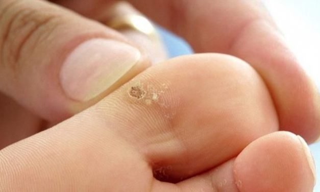 Qu’est-ce qu’une verrue plantaire ? Et comment les soigner dans une clinique podiatrique d’Aylmer ?