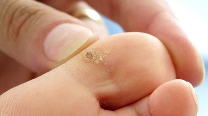 Tout savoir sur les verrues plantaires