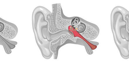 Pourquoi consulter un audiologiste à Ottawa ?