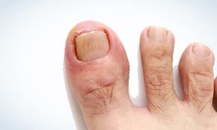 Dites Adieu aux Verrues Plantaires à Montréal : Options de Traitement Efficaces