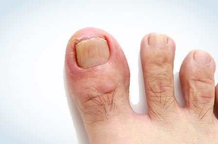 Dites Adieu aux Verrues Plantaires à Montréal : Options de Traitement Efficaces