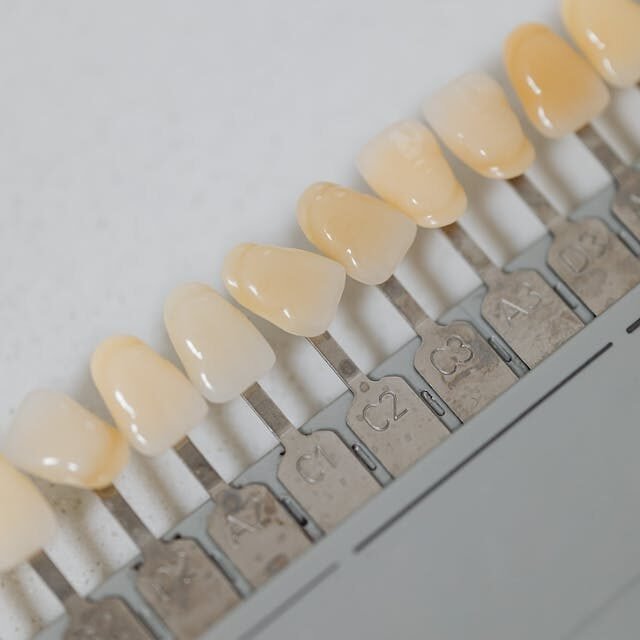 Découvrez les Avantages Exceptionnels de Notre Service de Prothèses Complètes Dentaires à Gatineau