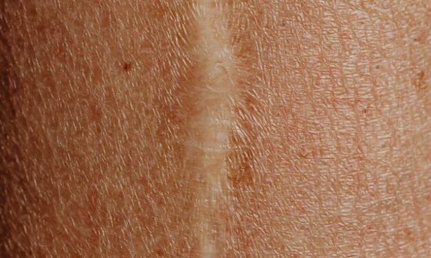 Scar Revision in Ottawa: Restoring Confidence